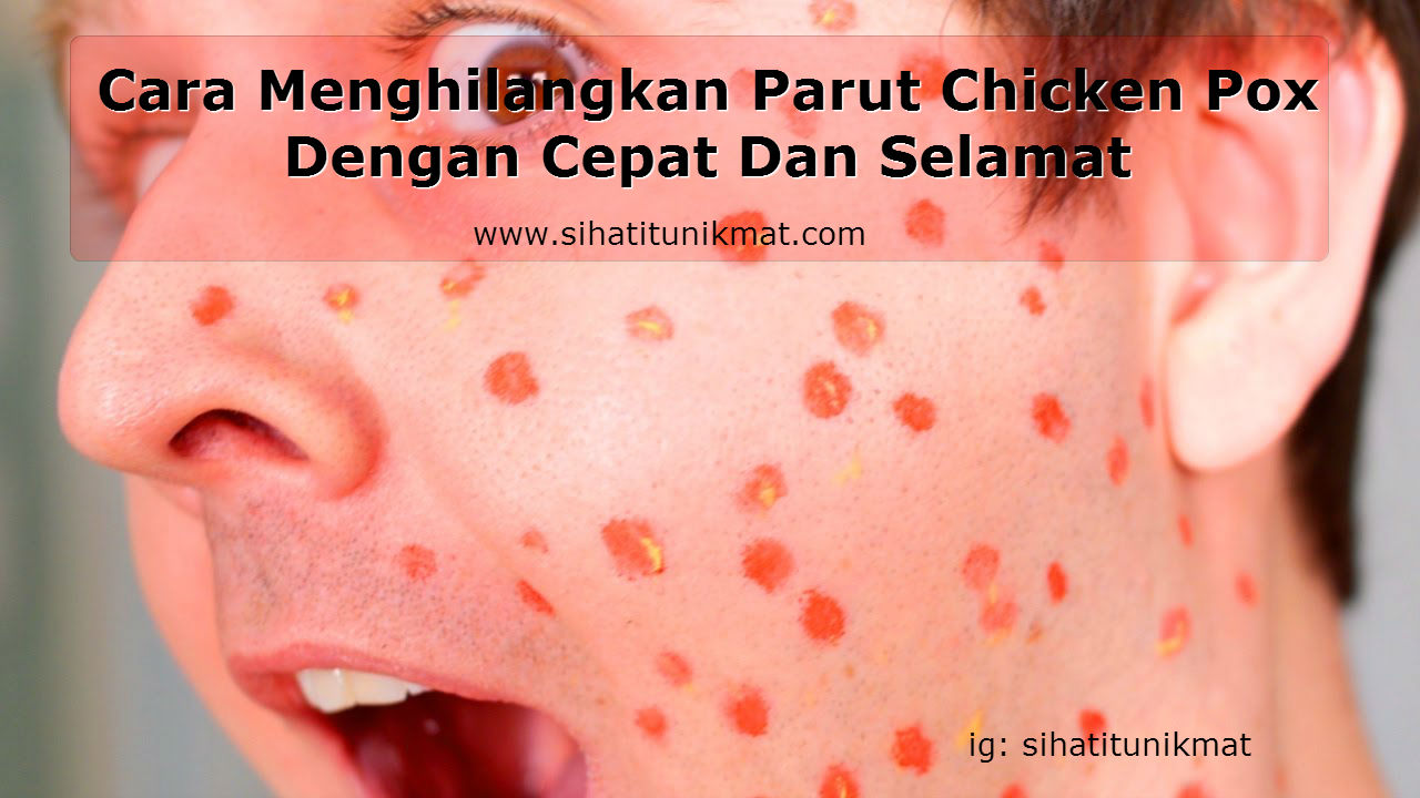 Cara Menghilangkan Parut Chicken Pox Dengan Cepat Dan Selamat Pengedar Shaklee Kota Damansara Pj