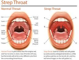 what causes strep throat