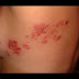 Shingles Infection Ayurvedic Treatment by Home Remedies