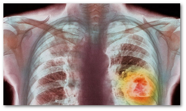 Diagnosticul si tratamentul abcesului pulmonar si a gangrenei pulmonare