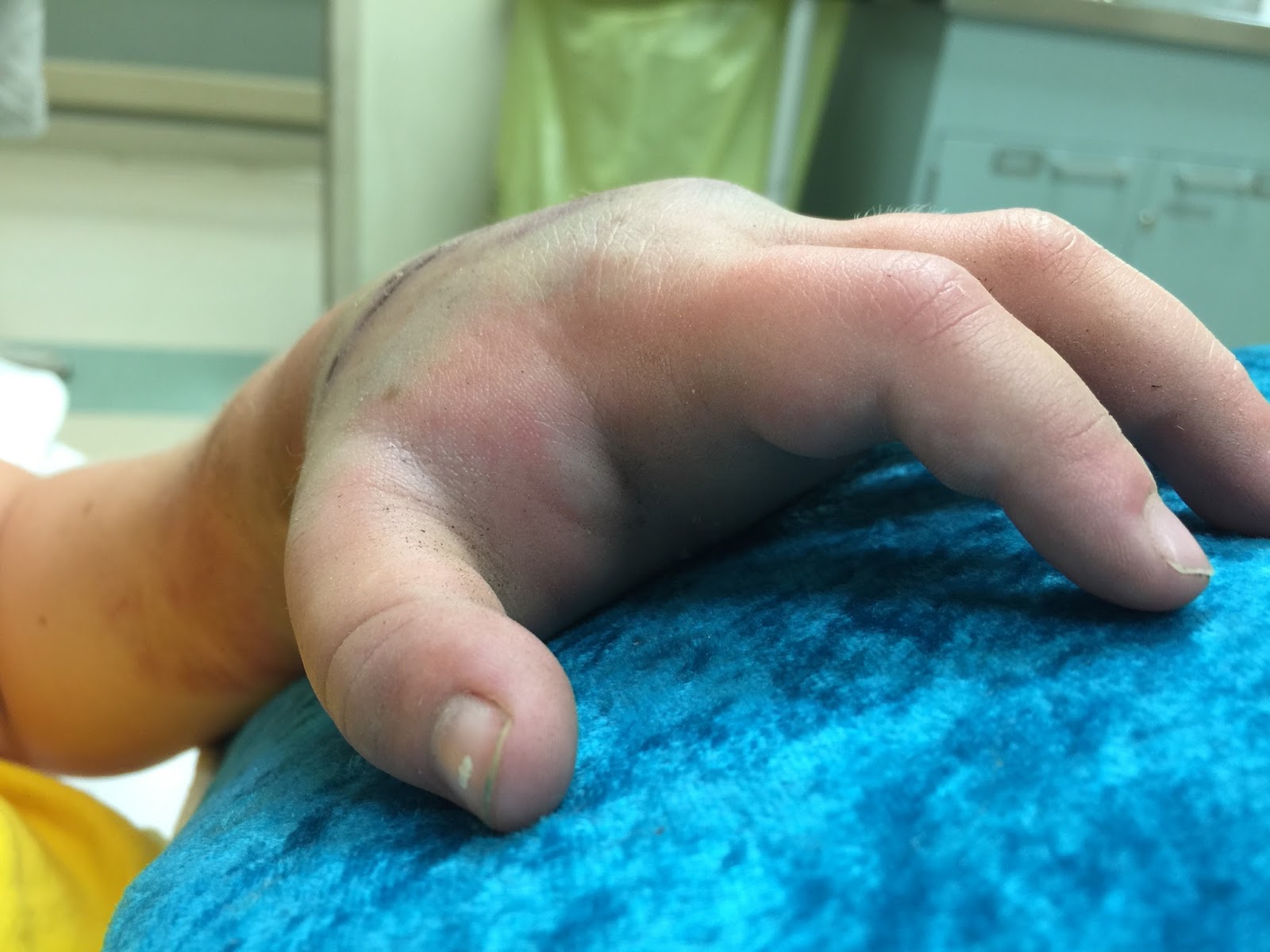 Mojoy: Gabbi's injured hand.