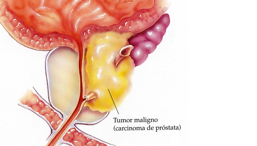 prostata quando operar