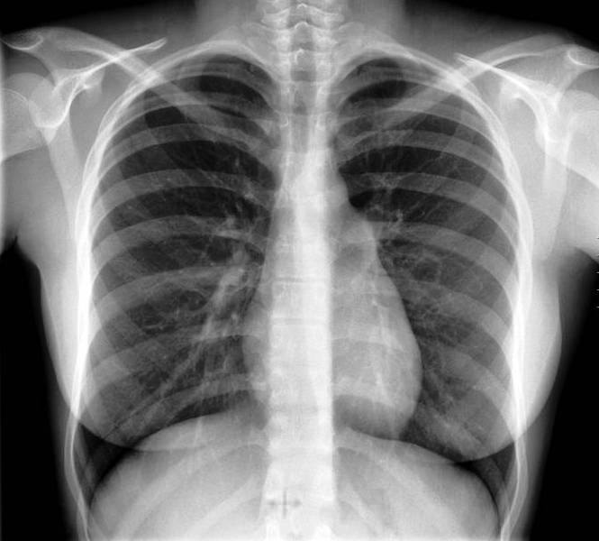 Arriba 105+ Imagen Radiografia De Un Corazon De Origami Lleno