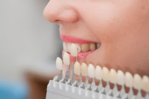 Tác dụng của dán răng sứ Veneer