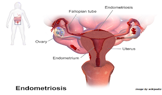 nyeri haid abnormal Endometriosis nyeri haid abnormal Endometriosis