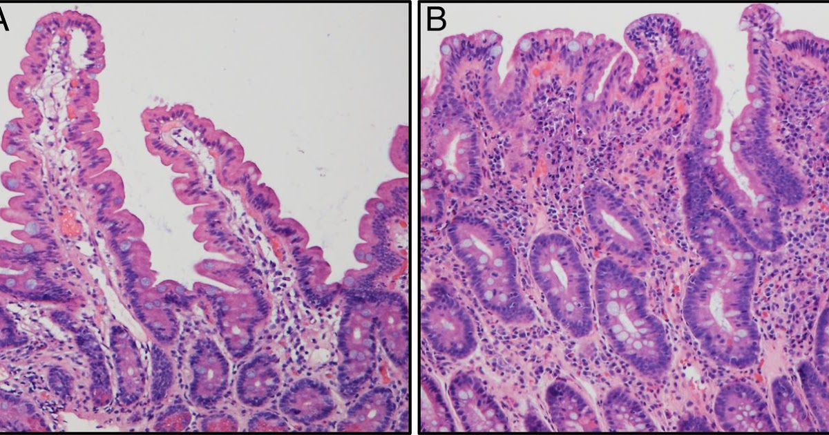 Study Medical Photos Screening and Diagnosis of Celiac Diseases
