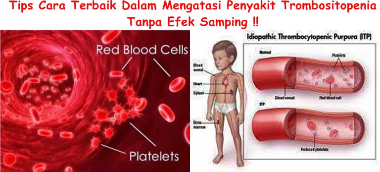 Pengobatan Tradisional Trombositopenia