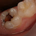 Cách nhận biết sâu răng dẫn đến ung thư