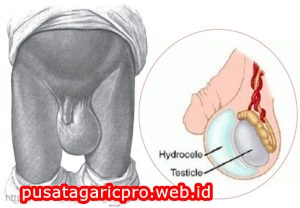 Cara Mengobati Buah Zakar Bengkak Dan Terasa Sakit Cara Mengobati Buah Zakar Bengkak Dan Terasa Sakit