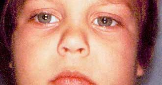 бактериальный паротит