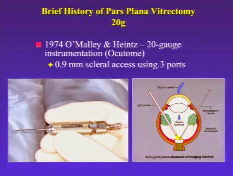 Ophthalmology OSCE: History of PPV