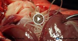 Voici ce qui se passe à l’intérieure  de votre corps quand vous mangez du porc (Medical Vidéo)