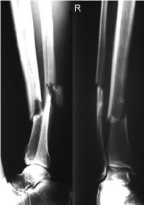 Anatomía aplicada a la Fisioterapia: Caso clínico: fractura tibia y peroné