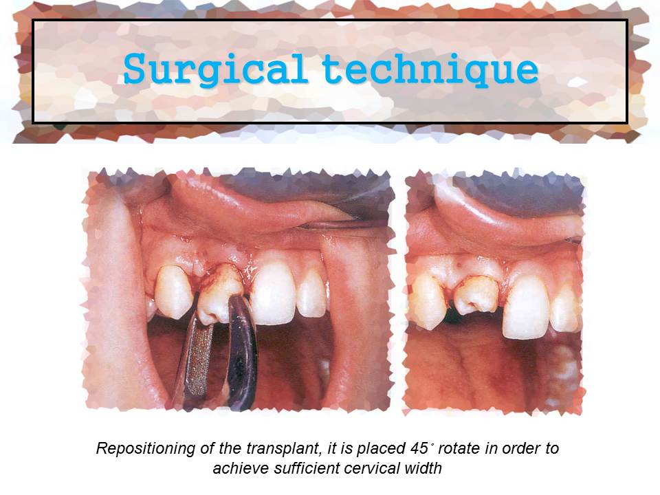 Dentistry: Tooth Transplantation