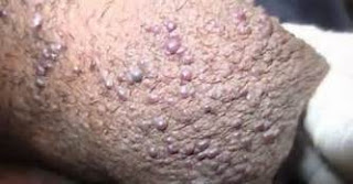 Obat Kutil Kelamin / Kondiloma De Nature di Surabaya Obat Kutil Kelamin / Kondiloma De Nature di Surabaya