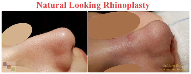 Natural Looking Rhinoplasty - Natural Nose Job - Natural Rhinoplasty - Female Nose Aesthetic Surgery - Nose Jobs For Women - Nose Reshaping for Women - Best Rhinoplasty For Women Istanbul - Female Rhinoplasty Istanbul - Nose Job Surgery for Women - Women's Rhinoplasty - Nose Aesthetic Surgery For Women - Female Rhinoplasty Surgery in Istanbul - Female Rhinoplasty Surgery in Turkey