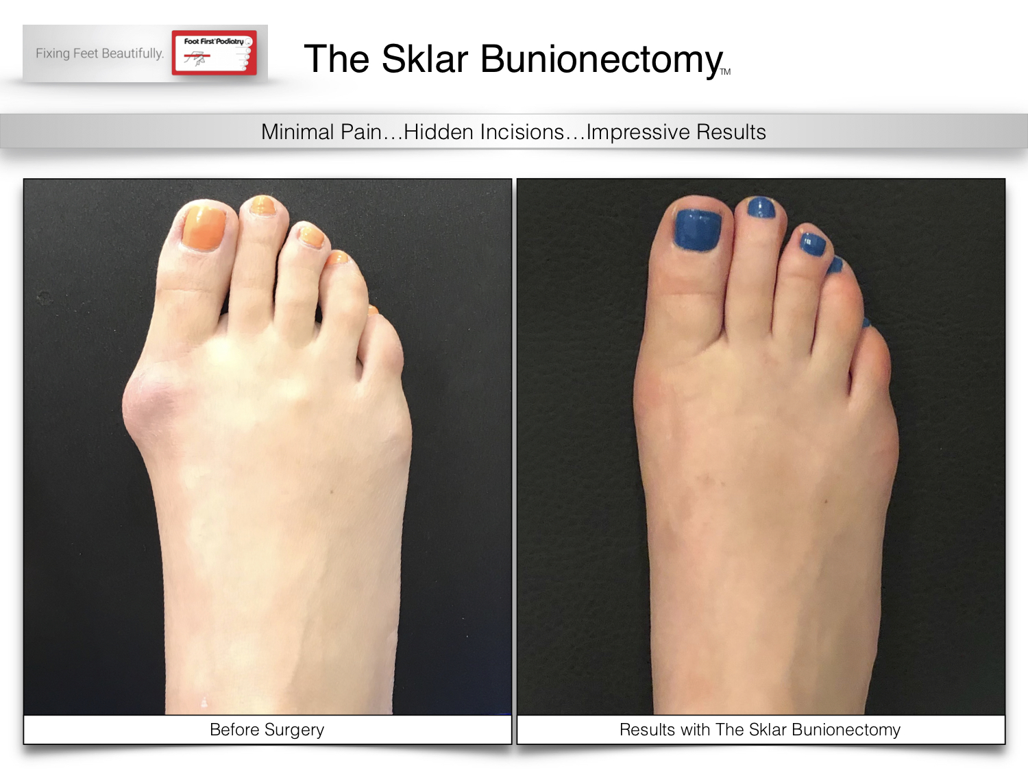 If Foot First can't come to YOU, then Travel to Foot First for Bunion Surgery...