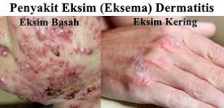 Menghilangkan Sakit Gatal Eksim Dengan Herbal, Bagaimana Cara Mengobati Sakit Eksim?, Bagaimana Mengobati Eksim Yang Menyiksa?
