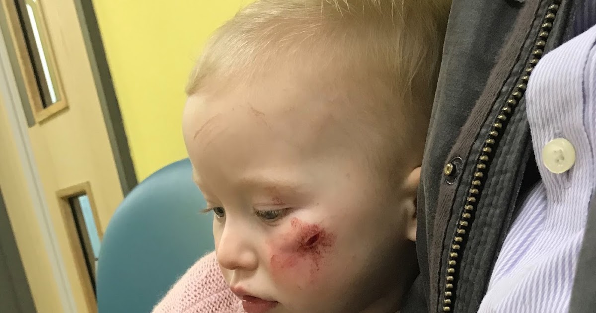 My Daughter S Cut Face And The Glue Which Didn T Help Counting To Ten