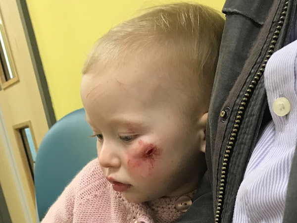 My Daughter's Cut Face And The Glue Which Didn't Help