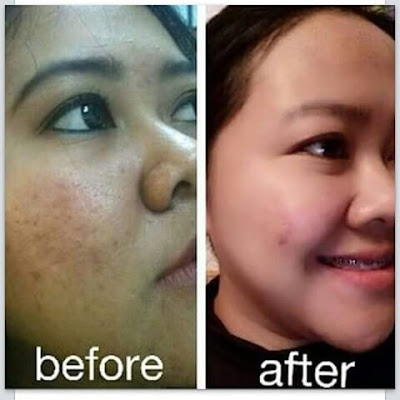 Cream Liyoskin Ampuh Atasi Kulit Berminyak Dan Berjerawat Cream Liyoskin Ampuh Atasi Kulit Berminyak Dan Berjerawat