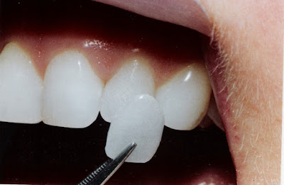 Bọc răng sứ Veneer có ưu điểm gì?