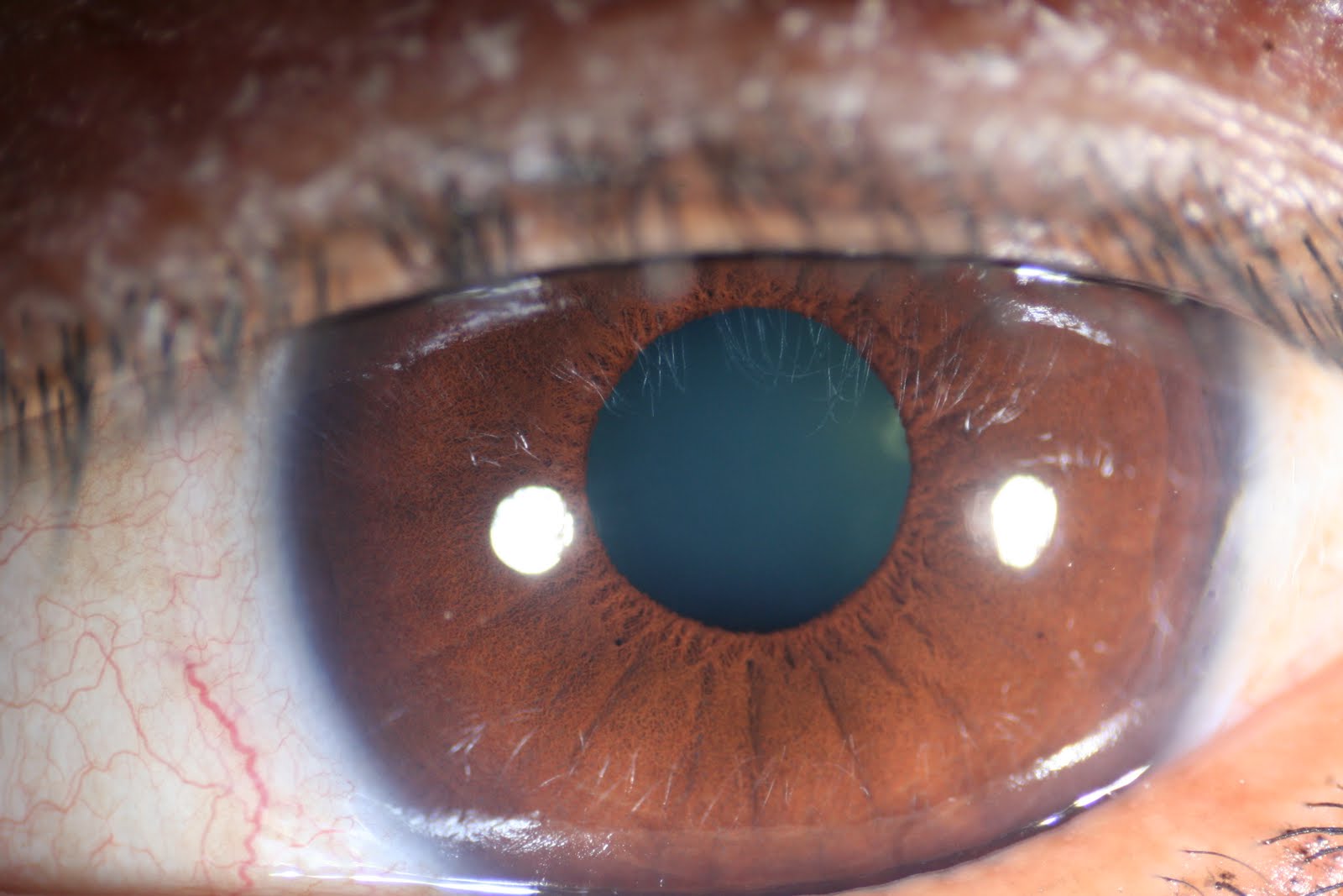modern-multidimensional-iridology-solitary-defect-marking