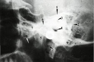 Dentistry lectures for MFDS/MJDF/NBDE/ORE: Note on Radiographic Anatomy