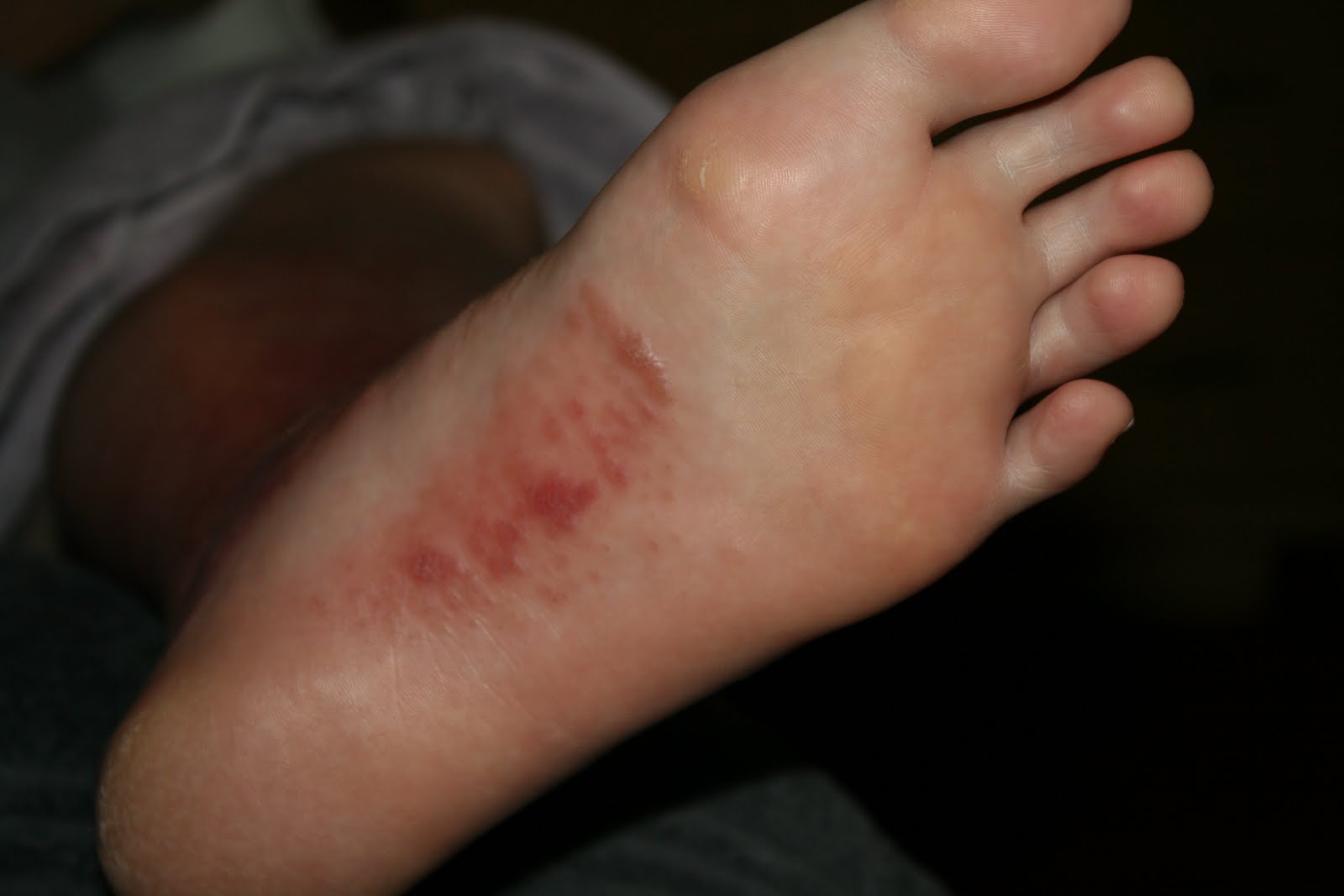 Tiny foot blisters - Dermatology - MedHelp