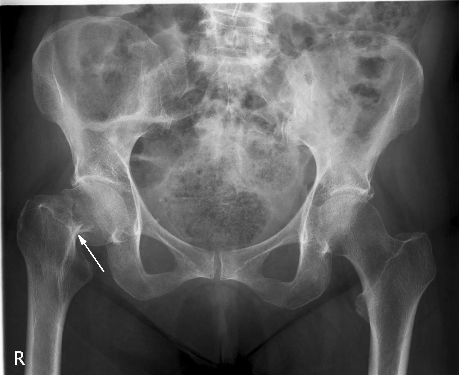 Трещина тазобедренного. Остеопороз бедренной кости рентген. Остеопороз костей таза рентген. Остеопороз тазобедренного сустава рентген.
