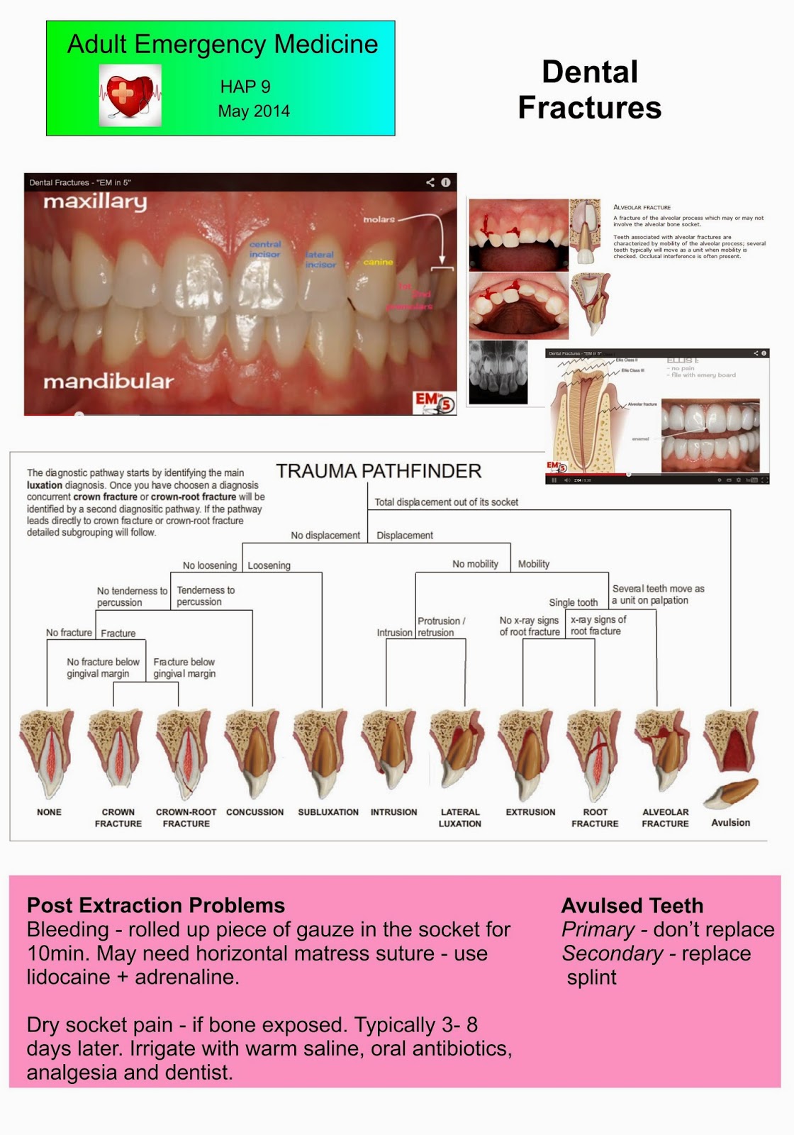 Adult Emergency Medicine Dental Fractures