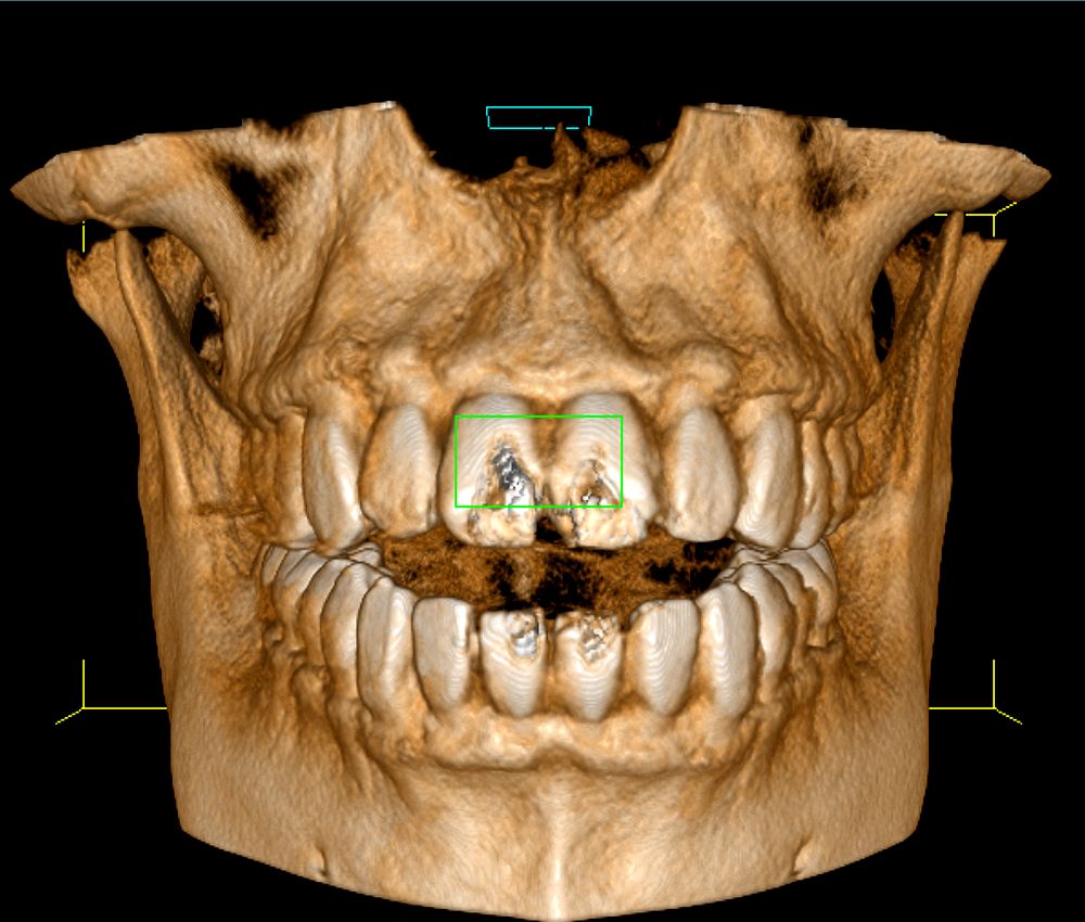 tomografía-odontológica
