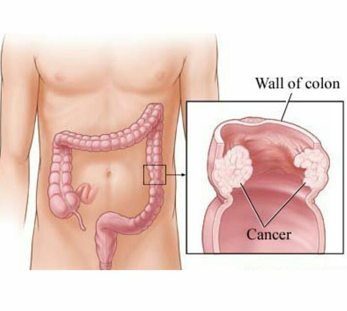 Рак толстой кишки выживаемость после операции. Раковая опухоль кишечника. Новообразования в прямой кишке.