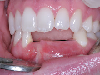Gãy răng hàm
