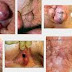Salep dan Obat Wasir Ambeien Ampuh thumbnail