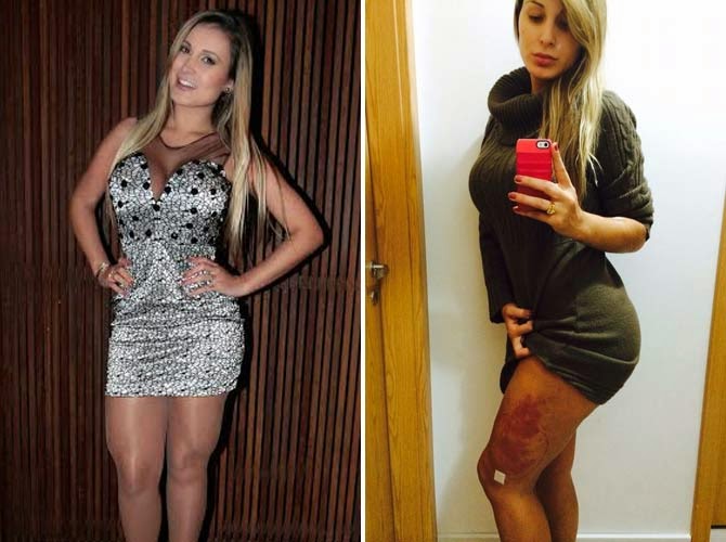 Andressa Urach retira líquido que deixava as pernas grossas Bauzão da Net Andressa Urach retira líquido que deixava as pernas grossas Bauzão da Net