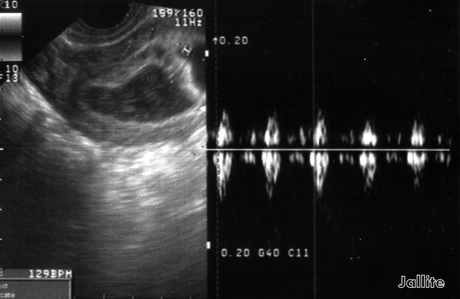 hematoma post prostático