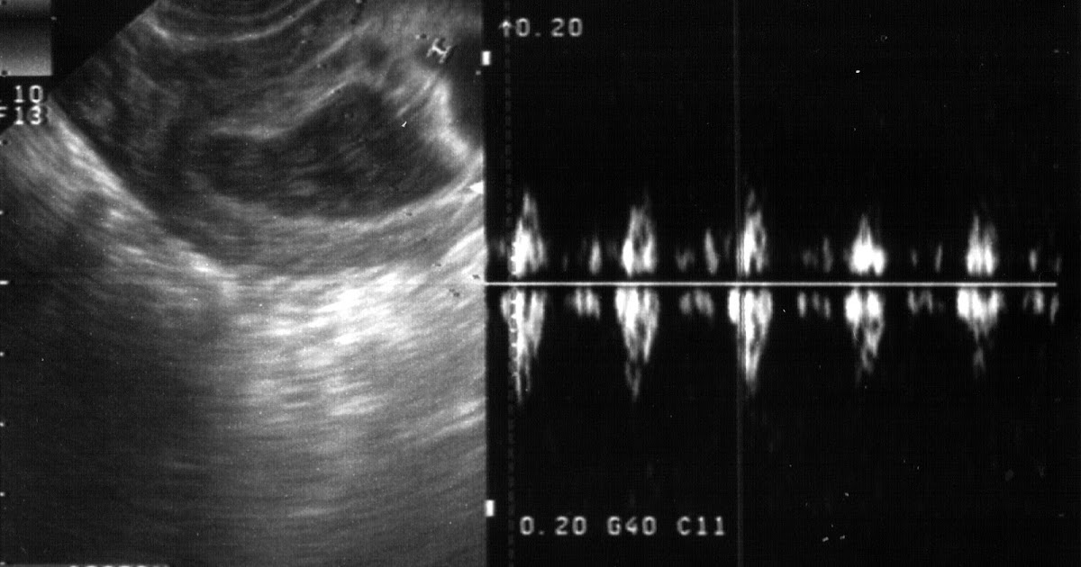 hematoma retrocorial cuanto tarda en desaparecer hematoma retrocorial cuanto tarda en desaparecer