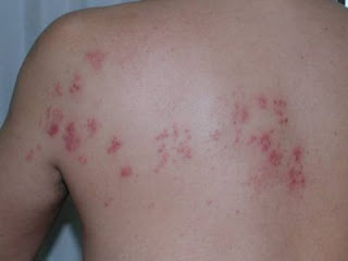 Como Prevenir El Herpes Como Prevenir El Herpes