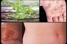 Obat Sipilis Tradisional Obat Sipilis Tradisional