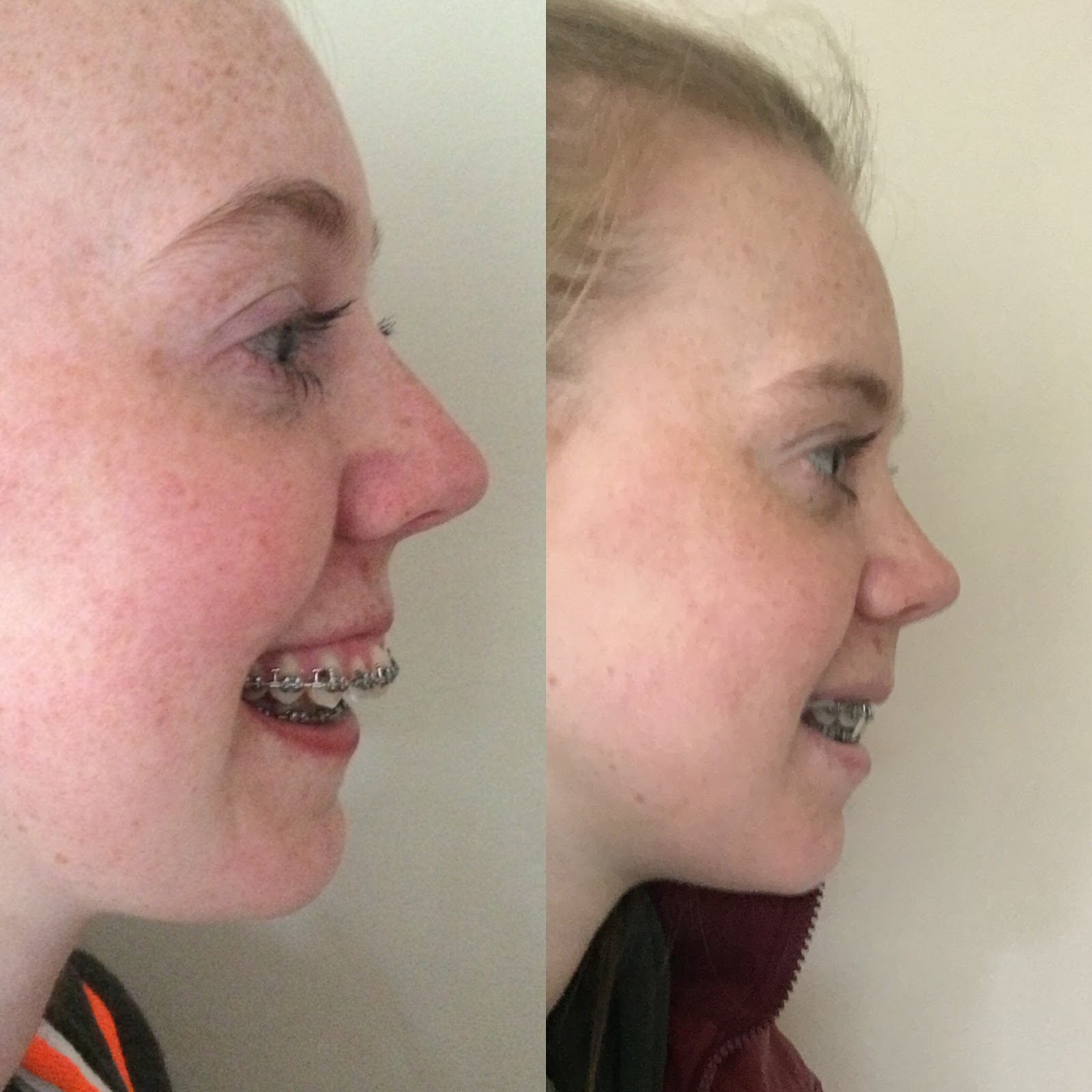 Summer's double jaw surgery blog (NHS) Day 11 and 12 postop