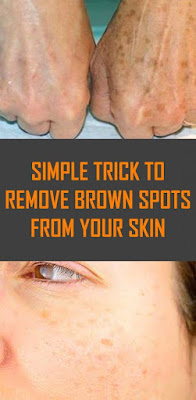 Simple Trick to Remove Brown Spots from Your Skin - EXPLORE HEALTH