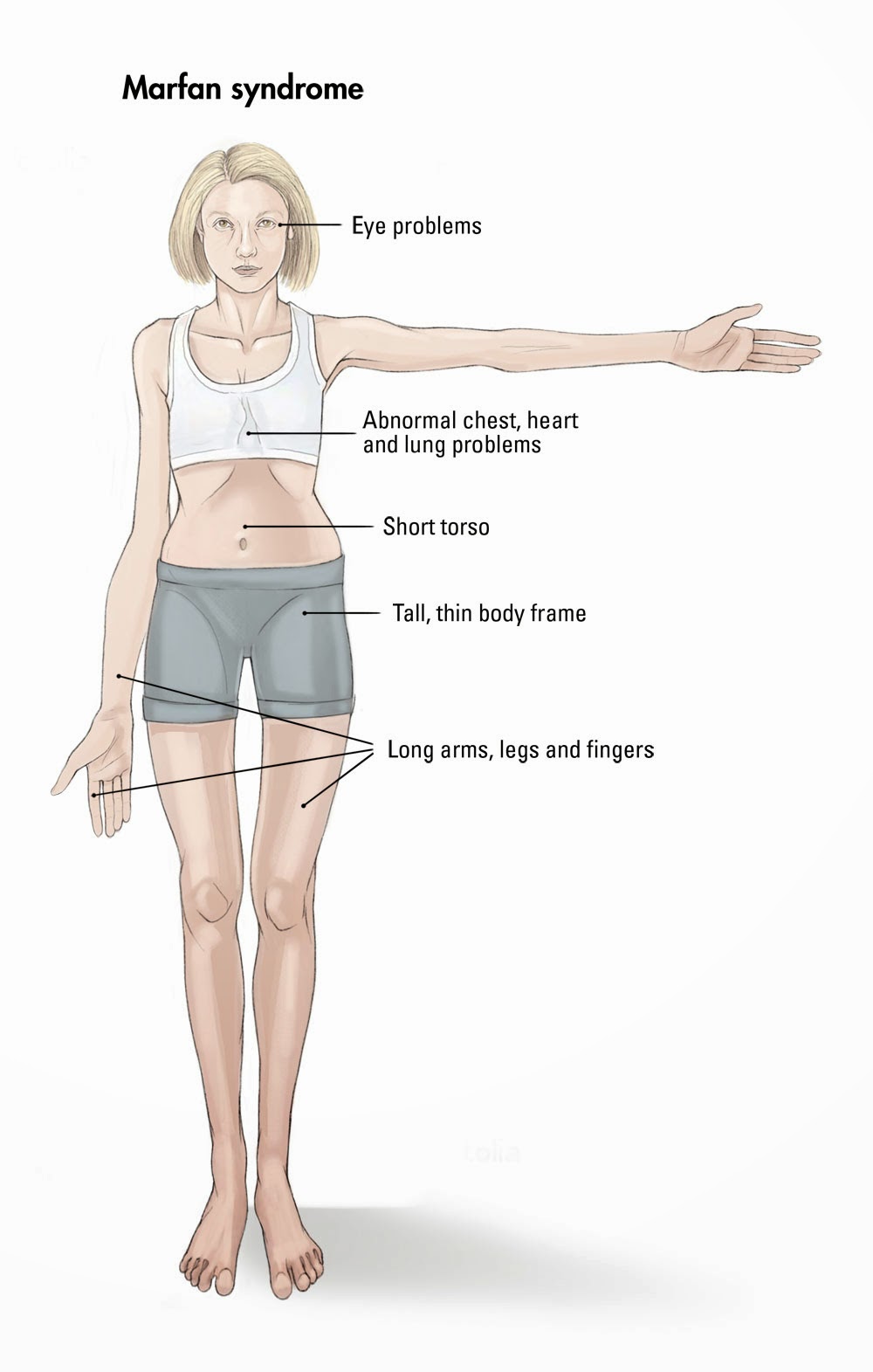 Marfan Syndrome Effects on the body