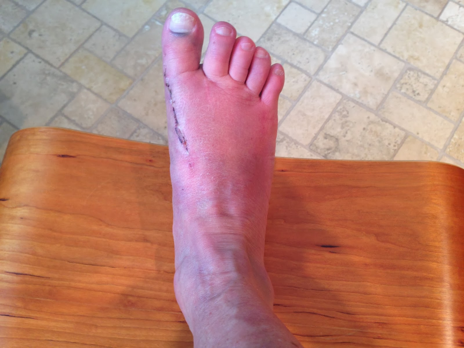 Lisa's Big Toe Fusion December 2, 2013