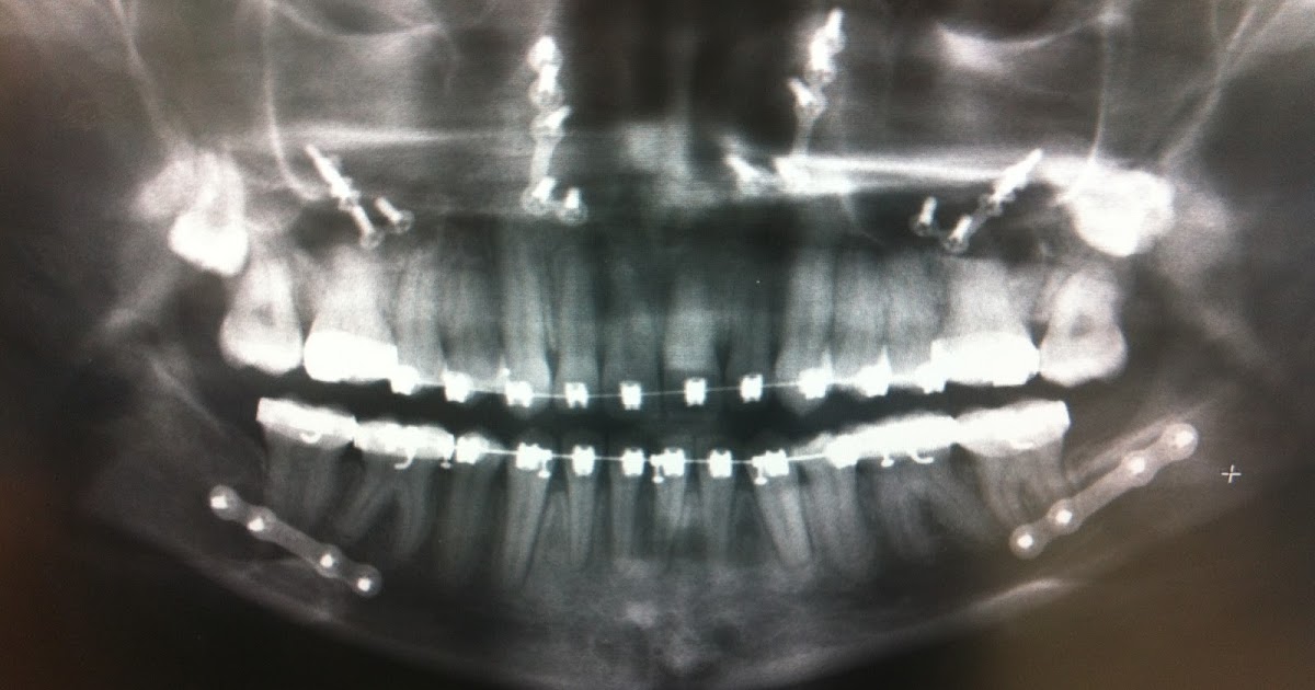 A Guide to Surviving Orthognathic Surgery Looking in the Mirror after