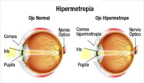 hipermetropia este atunci când văd vitaminele redau vederea