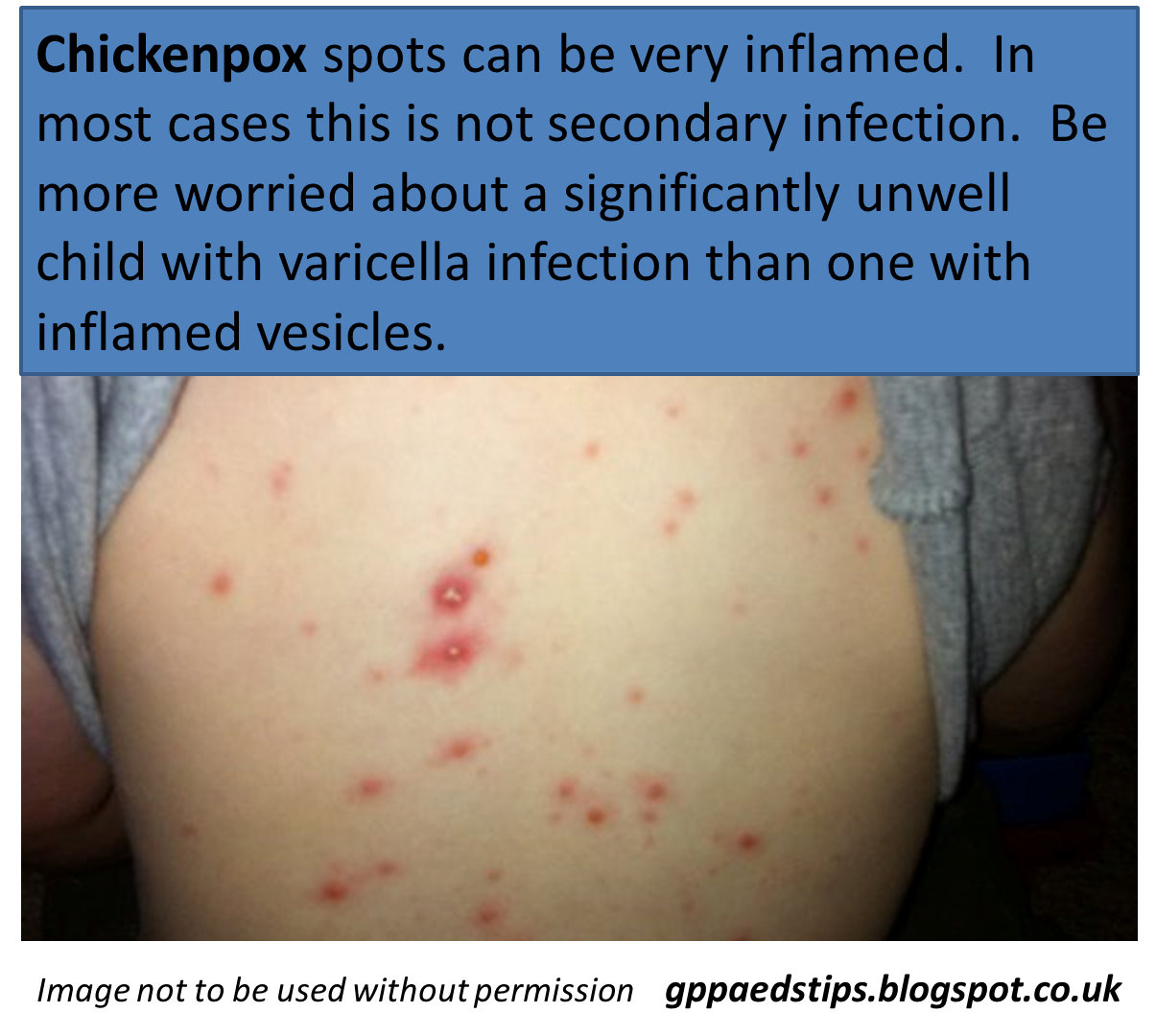 Paediatrics for Primary Care (and anyone else) Rashes in children