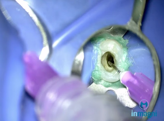 ENDODONTIA: Endo canal achatado + instalação de pino de fibra