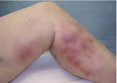 Superficial Phlebitis & Thrombophlebitis