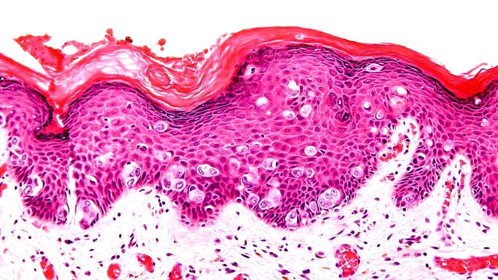 Extramammary Paget's disease Extramammary Paget's disease